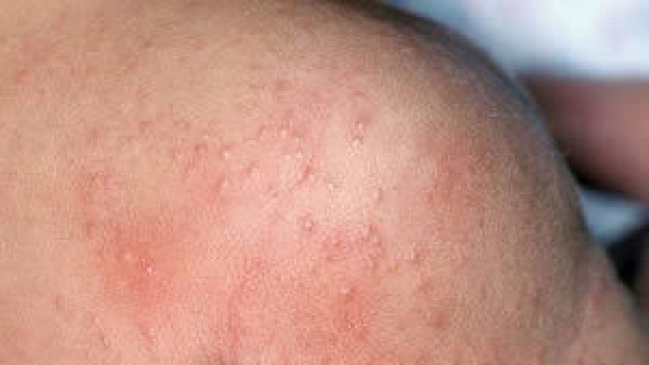 İsilik nasıl geçer ? İsilik Belirtileri ve Tedavisi Canım Anne